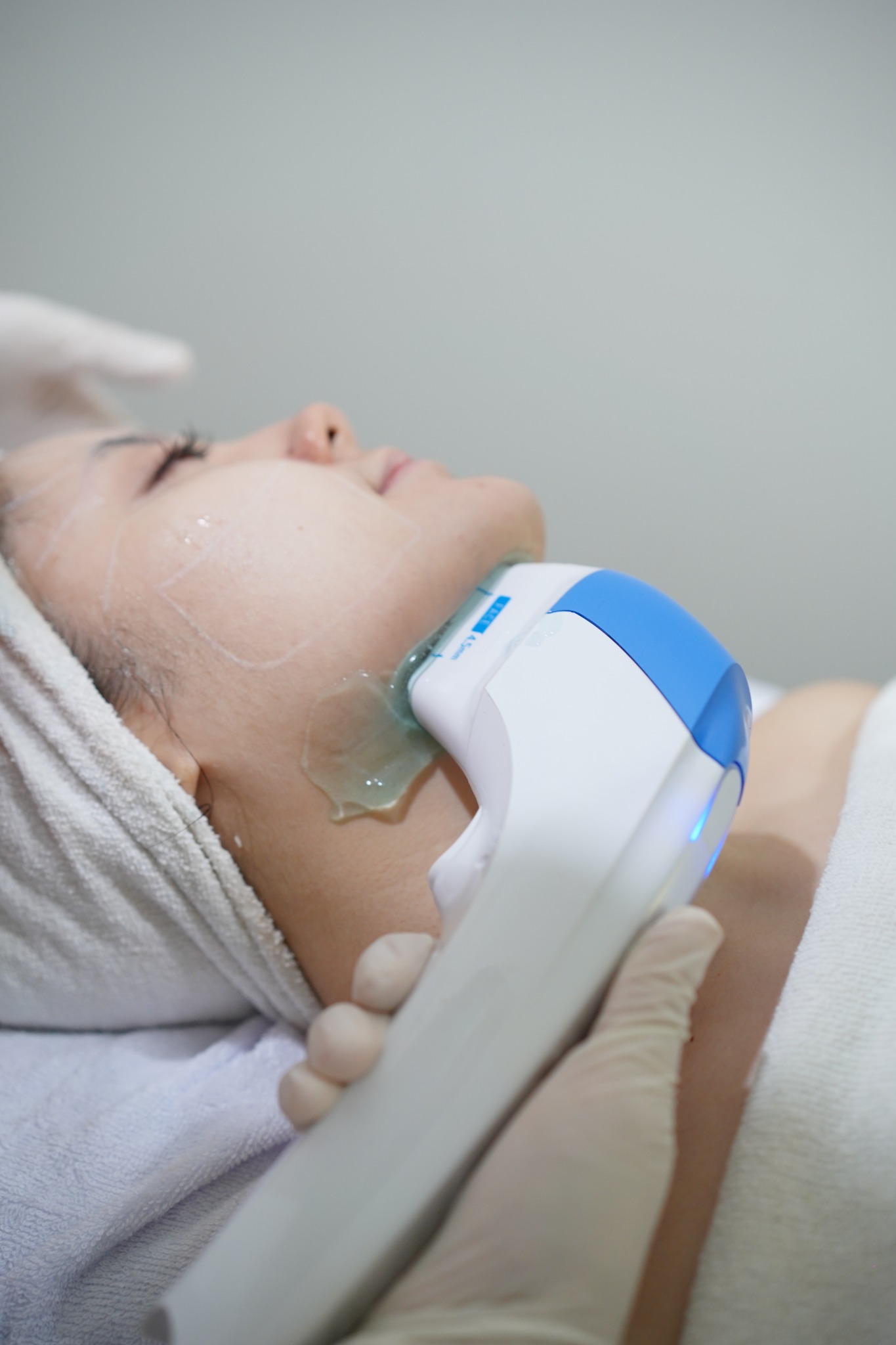 Dokumentasi treatment HIFU & Contouring CHARISMA